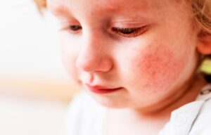 Eczema in Children and Adults
